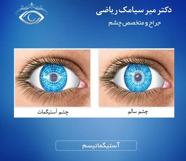 آستیگماتیسم