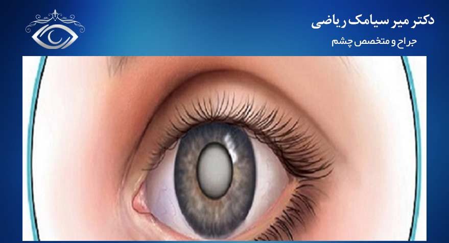 کاتاراکت یا آب مروارید
