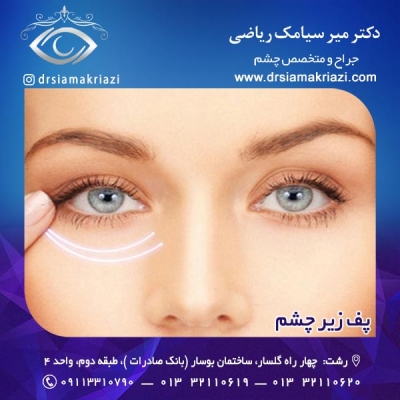 پف زیر چشم - دکتر سیامک ریاضی