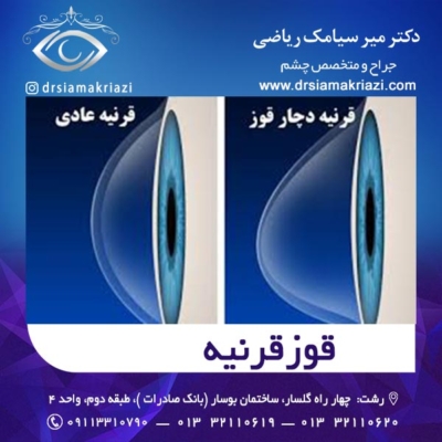 قوز قرنیه - دکتر سیامک ریاضی