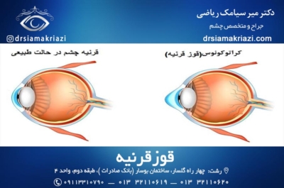 قوز قرنیه - دکتر سیامک ریاضی